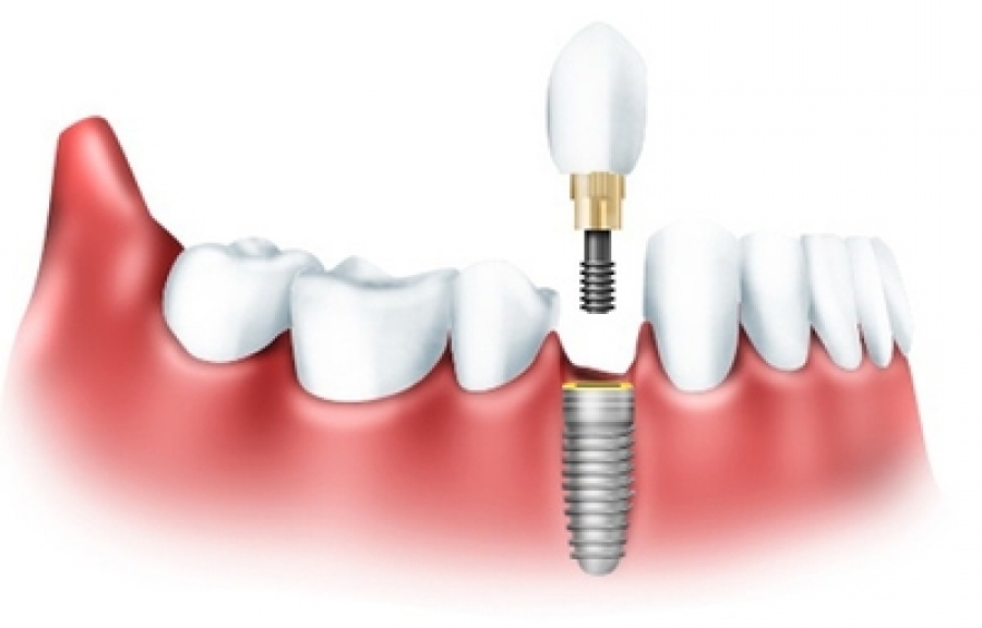 implantacija-zubov-1
