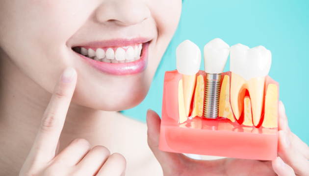 implantacija-zubov-2