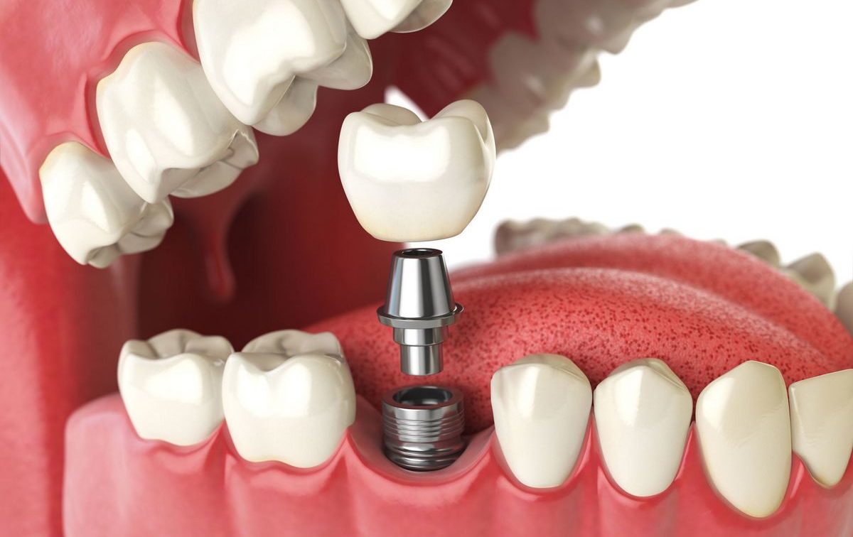 implantacija-zubov-3