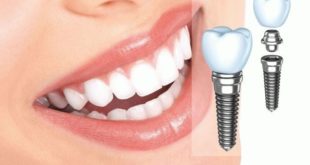 implantacija-zubov-5