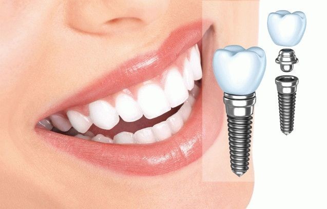 implantacija-zubov-5